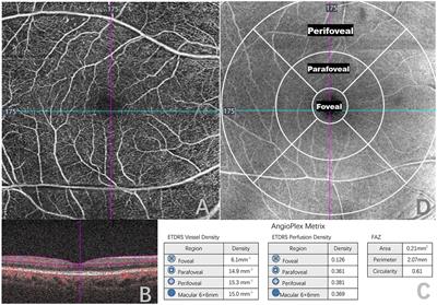 The association between retinal microvasculature derived from optical coherence tomography angiography and systemic factors in type 2 diabetics